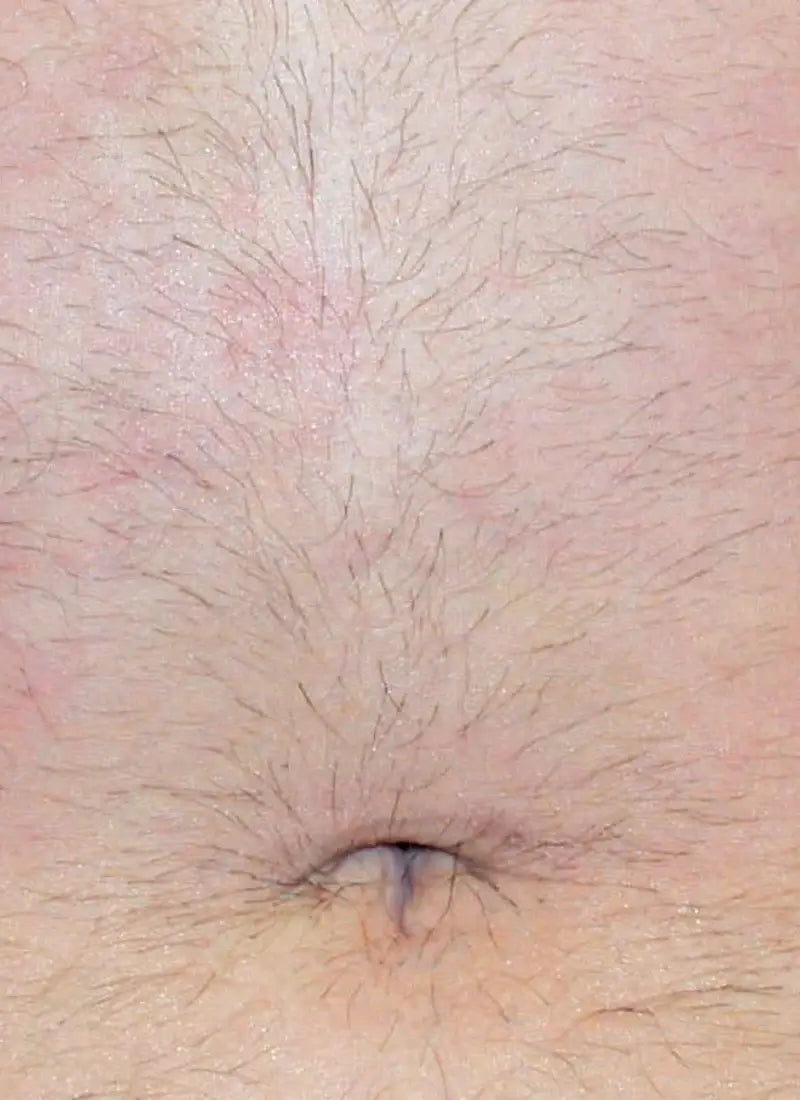 Antes - Abdomen