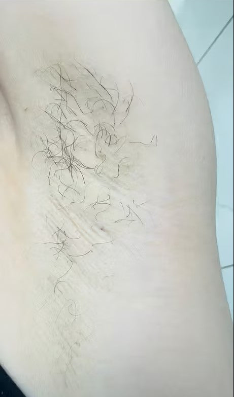 Antes - Axilas