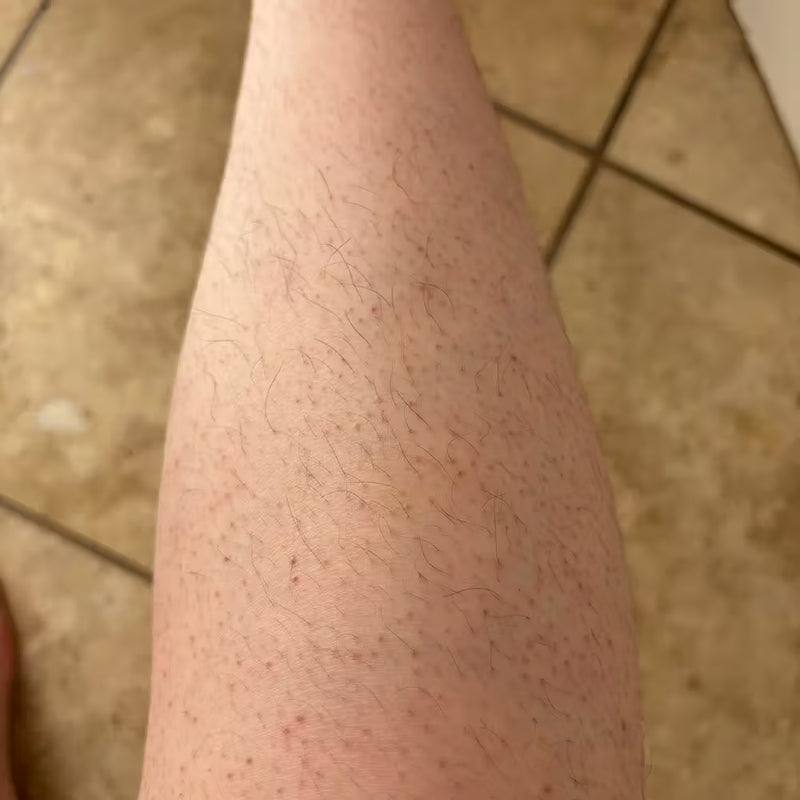 Antes - Piernas